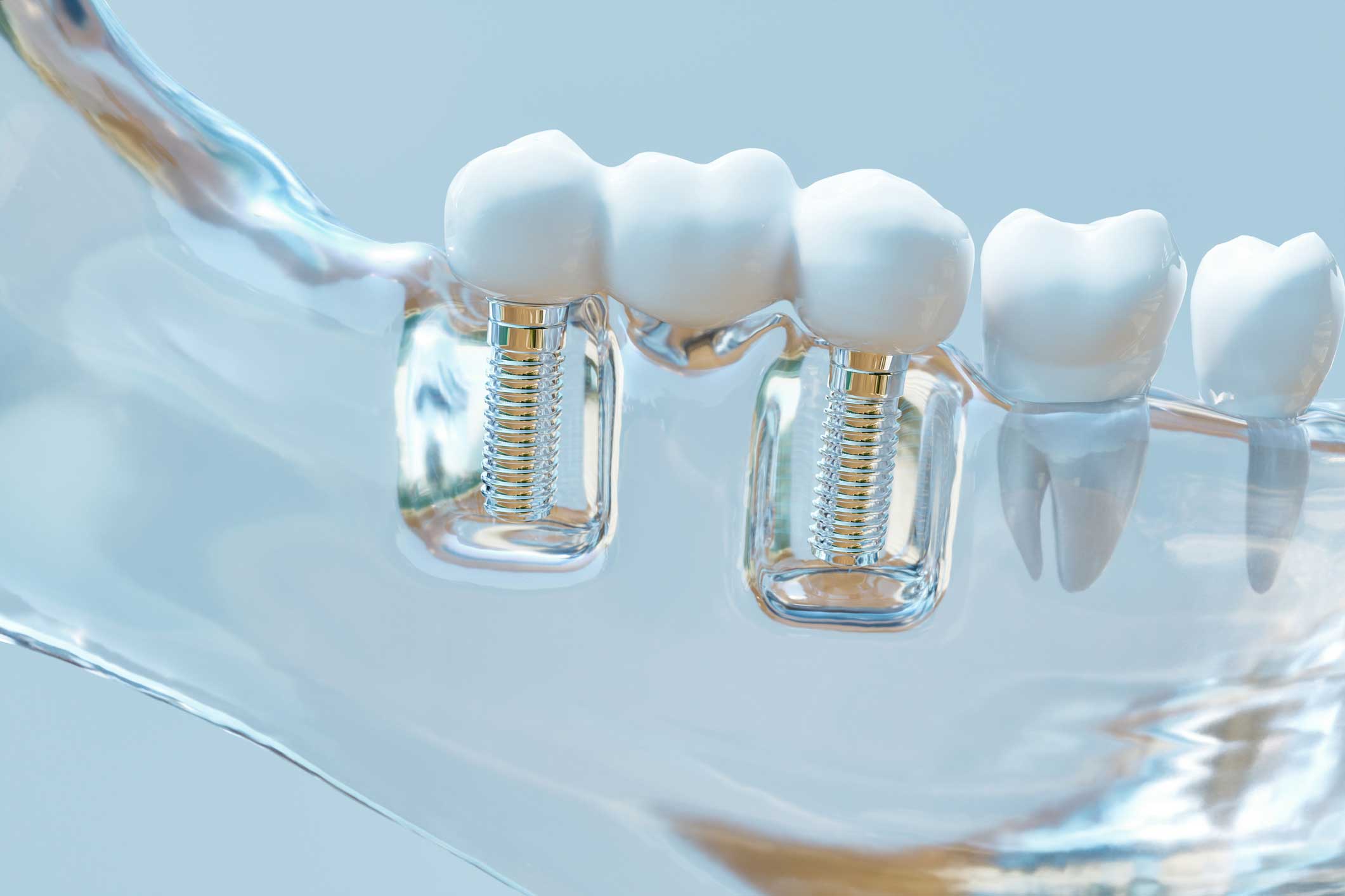Dentista en Madrid, Clínica Dental en Madrid, implantología en Madrid