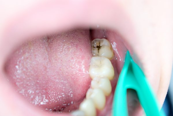 qué caries